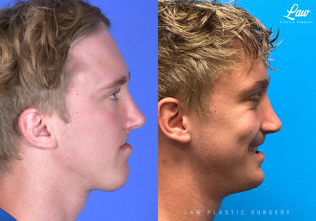 Jaw Surgery Before and After Photo. Surgery performed in Dallas, TX at Law Plastic Surgery.