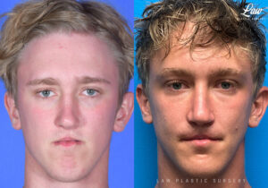Jaw Surgery Before and After Photo. Surgery performed in Dallas, TX at Law Plastic Surgery.