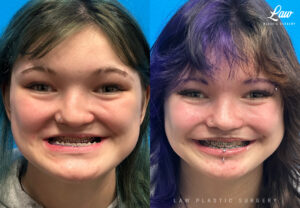 Jaw Surgery Before and After Photo. Surgery performed in Dallas, TX at Law Plastic Surgery.