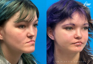 Jaw Surgery Before and After Photo. Surgery performed in Dallas, TX at Law Plastic Surgery.