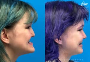 Jaw Surgery Before and After Photo. Surgery performed in Dallas, TX at Law Plastic Surgery.