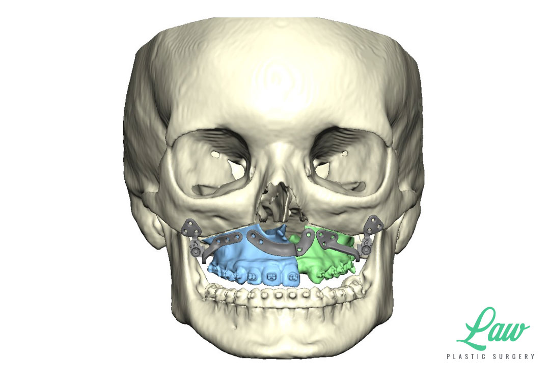 Jaw Surgery Before and After Photo. Surgery performed in Dallas, TX at Law Plastic Surgery.