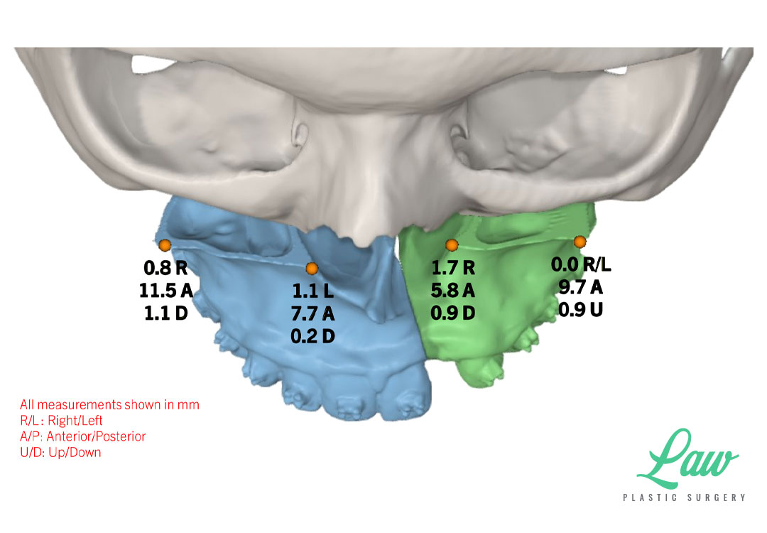 Jaw Surgery Before and After Photo. Surgery performed in Dallas, TX at Law Plastic Surgery.