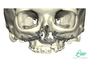 Jaw Surgery Before and After Photo. Surgery performed in Dallas, TX at Law Plastic Surgery.