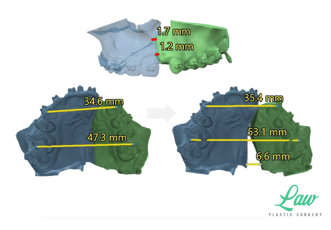 Jaw Surgery Before and After Photo. Surgery performed in Dallas, TX at Law Plastic Surgery.