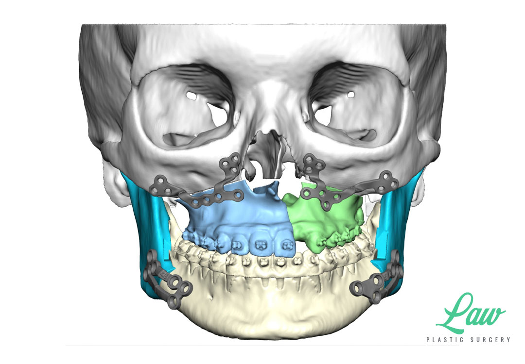 Jaw Surgery Before and After Photo. Surgery performed in Dallas, TX at Law Plastic Surgery.