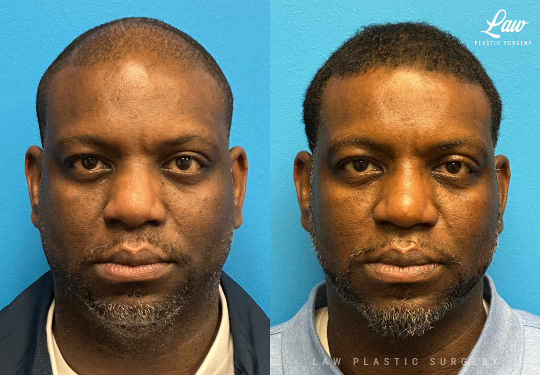 Rhinoplasty (Nose Job) Before & After Photo. Surgery performed in Dallas, TX at Law Plastic Surgery.