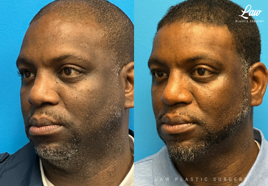 African American Rhinoplasty Before & After Photo. Surgery performed in Dallas, TX at Law Plastic Surgery.