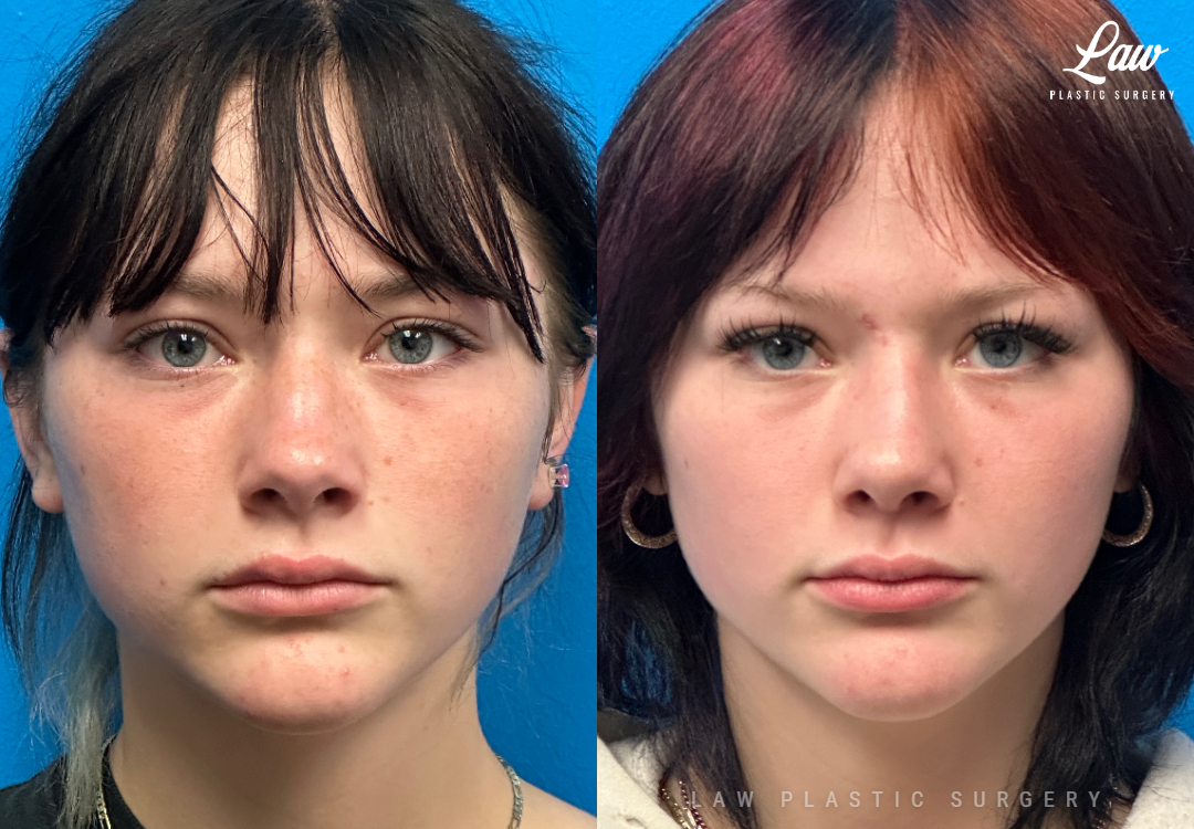 Rhinoplasty (Nose Job) Before & After Photo. Surgery performed in Dallas, TX at Law Plastic Surgery.