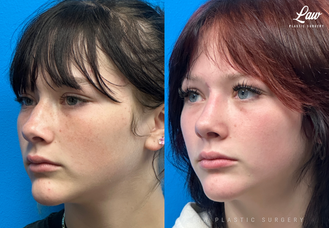 Rhinoplasty (Nose Job) Before & After Photo. Surgery performed in Dallas, TX at Law Plastic Surgery.