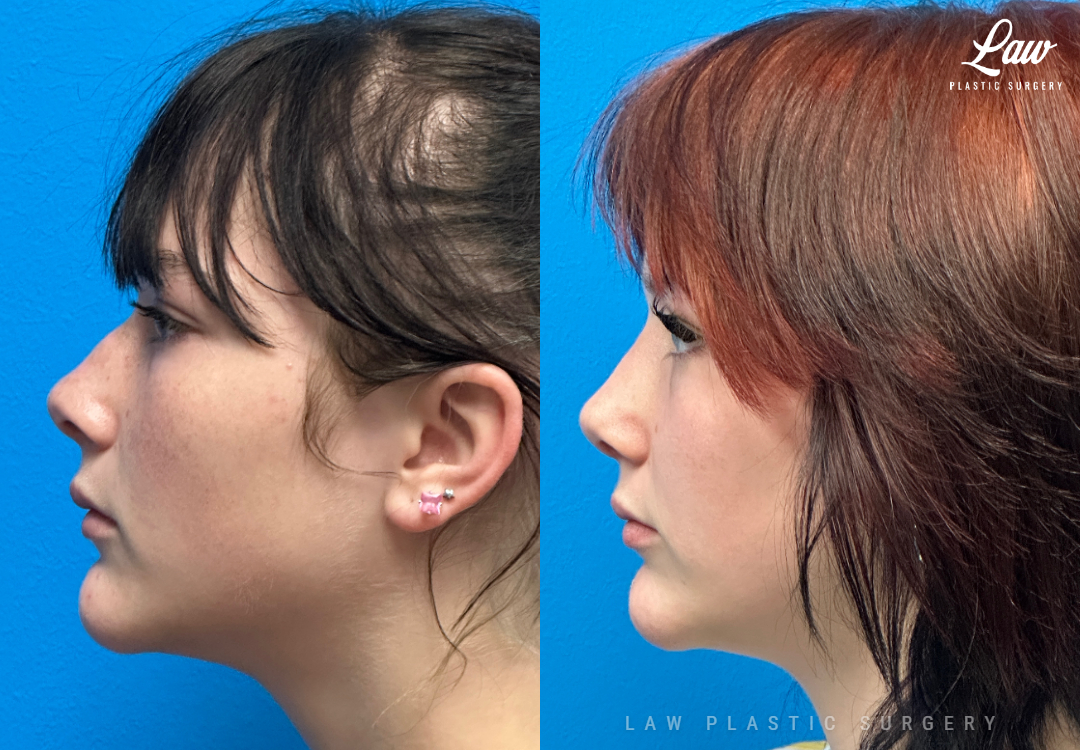 Rhinoplasty (Nose Job) Before & After Photo. Surgery performed in Dallas, TX at Law Plastic Surgery.