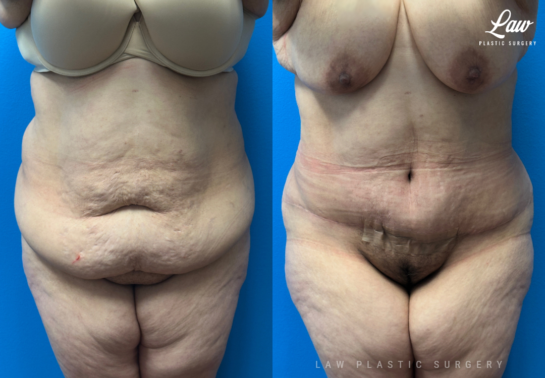 Tummy Tuck (Abdominoplasty) Before and After Photo. Surgery performed in Dallas, TX at Law Plastic Surgery.