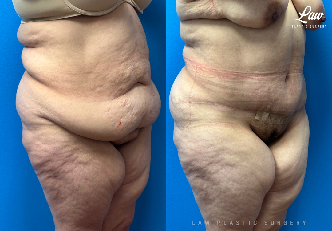 Tummy Tuck (Abdominoplasty) Before and After Photo. Surgery performed in Dallas, TX at Law Plastic Surgery.