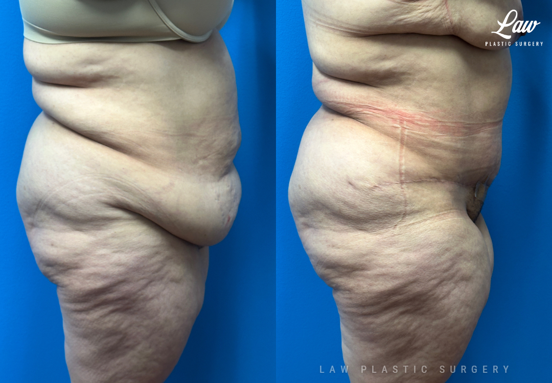 Tummy Tuck (Abdominoplasty) Before and After Photo. Surgery performed in Dallas, TX at Law Plastic Surgery.