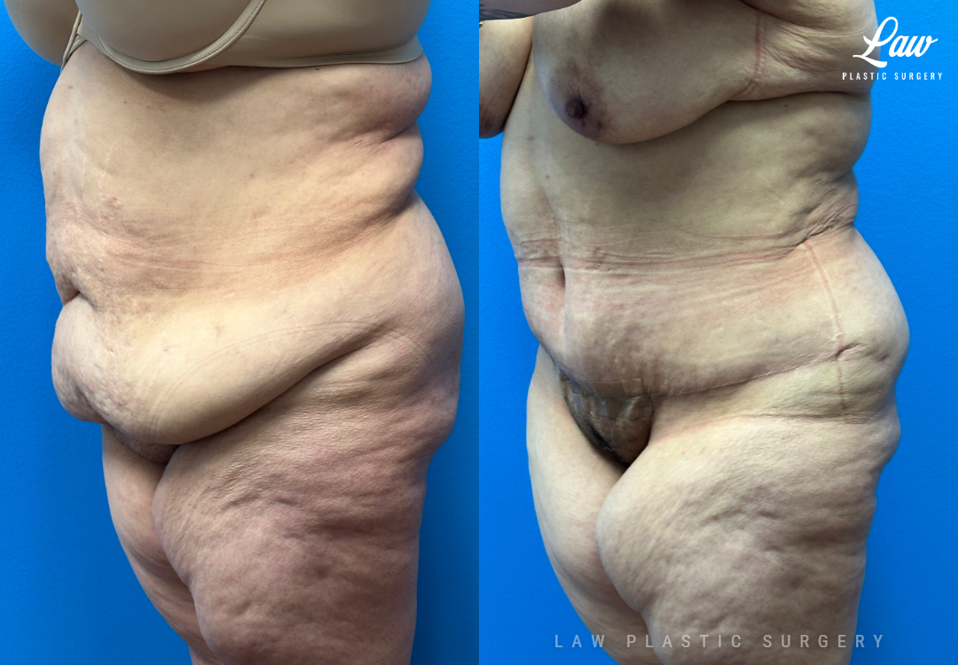 Tummy Tuck (Abdominoplasty) Before and After Photo. Surgery performed in Dallas, TX at Law Plastic Surgery.