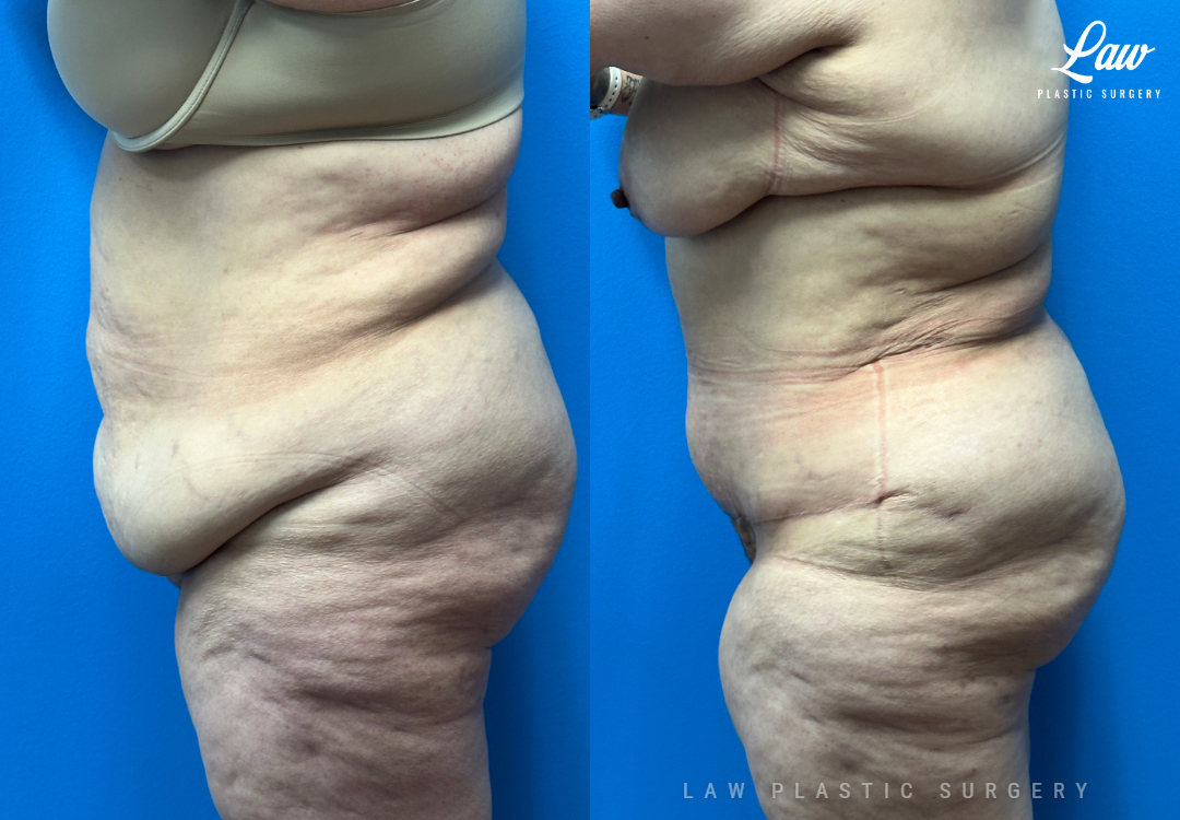 Tummy Tuck (Abdominoplasty) Before and After Photo. Surgery performed in Dallas, TX at Law Plastic Surgery.