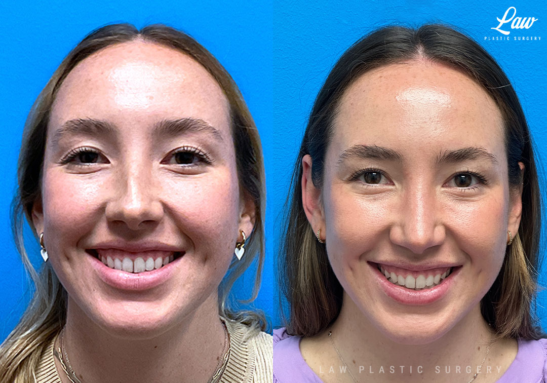 Rhinoplasty (Nose Job) Before & After Photo. Surgery performed in Dallas, TX at Law Plastic Surgery.