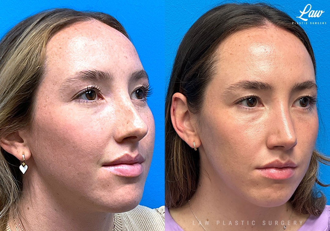 Rhinoplasty (Nose Job) Before & After Photo. Surgery performed in Dallas, TX at Law Plastic Surgery.