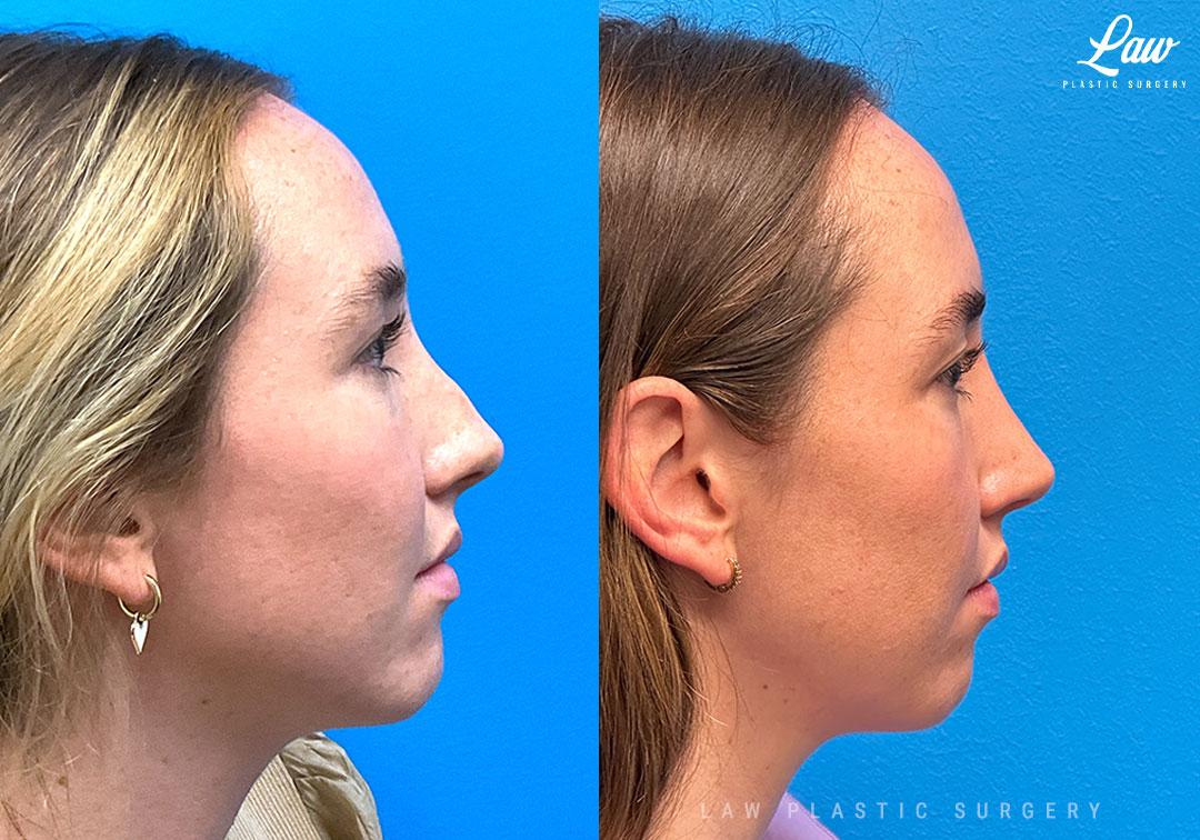 Rhinoplasty (Nose Job) Before & After Photo. Surgery performed in Dallas, TX at Law Plastic Surgery.