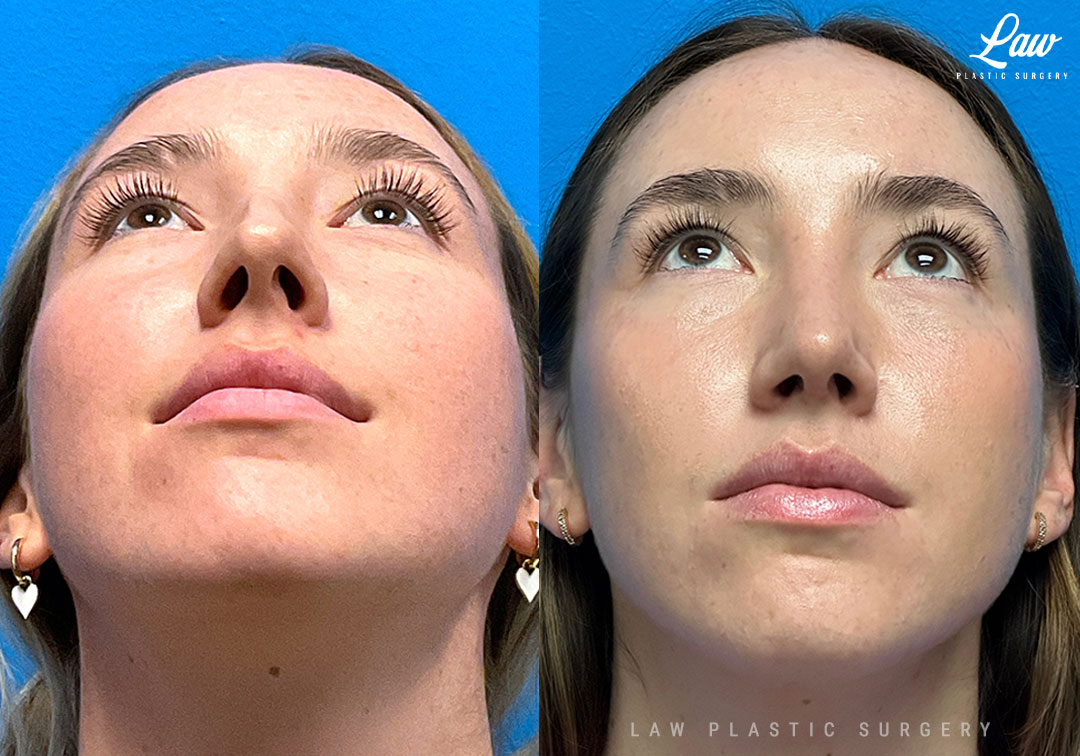 Rhinoplasty (Nose Job) Before & After Photo. Surgery performed in Dallas, TX at Law Plastic Surgery.