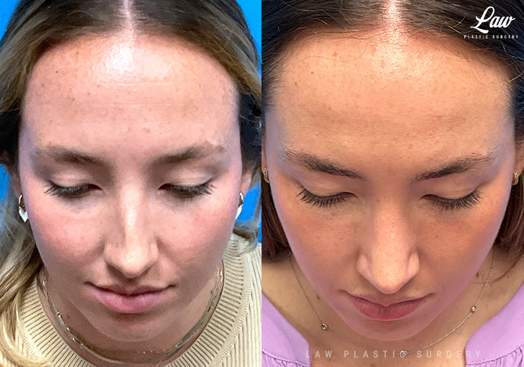 Rhinoplasty (Nose Job) Before & After Photo. Surgery performed in Dallas, TX at Law Plastic Surgery.