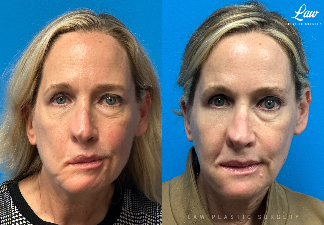 Chin Surgery (Genioplasty) Before and After Photo. Surgery performed in Dallas, TX at Law Plastic Surgery.