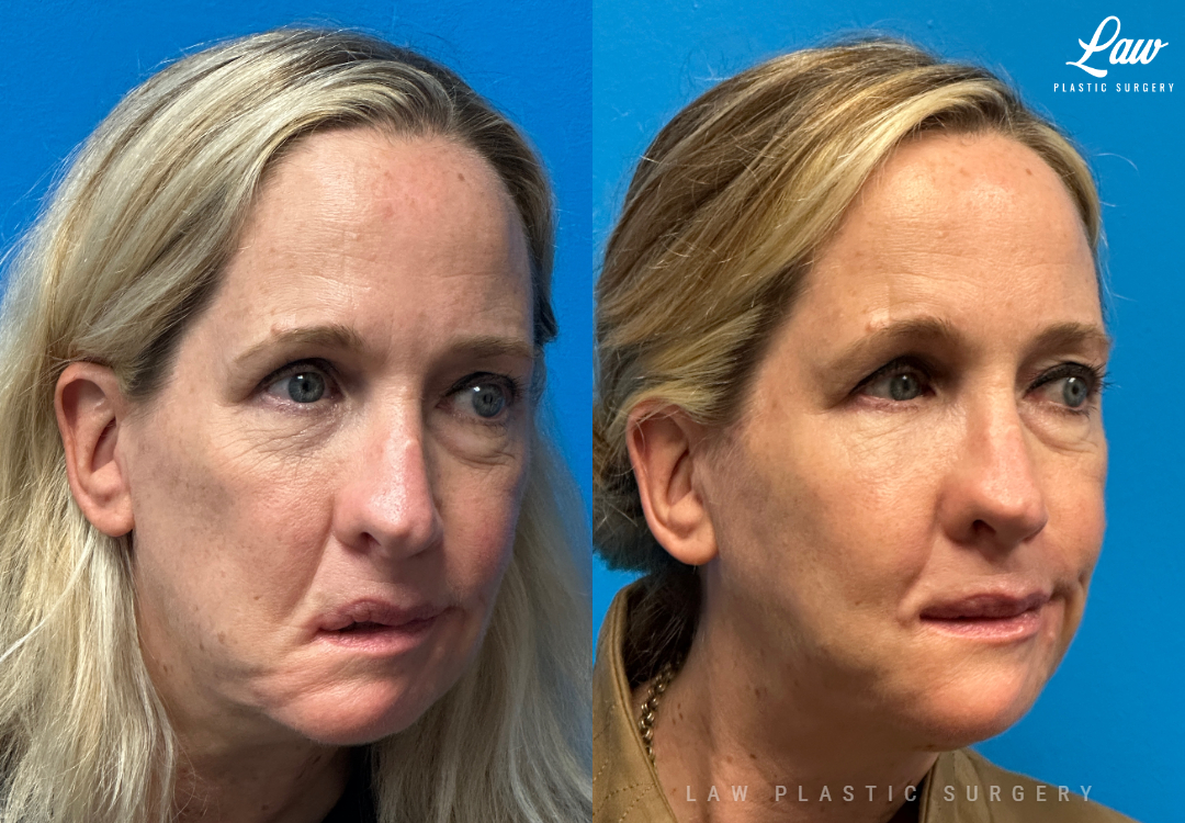 Chin Surgery (Genioplasty) Before and After Photo. Surgery performed in Dallas, TX at Law Plastic Surgery.