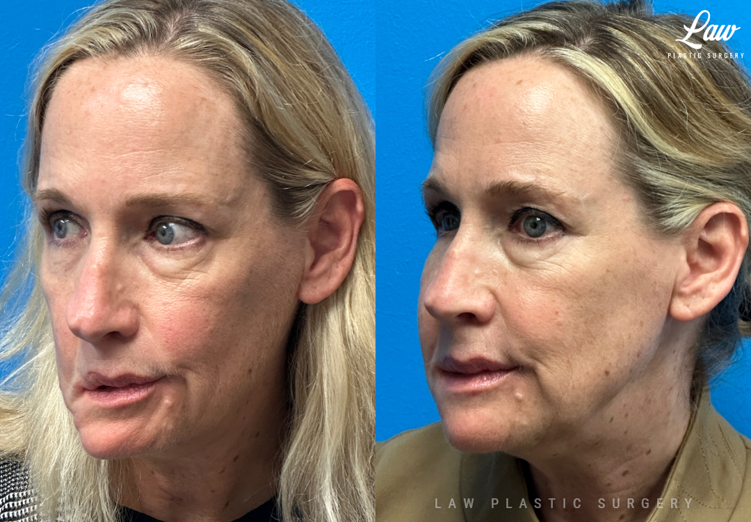 Chin Surgery (Genioplasty) Before and After Photo. Surgery performed in Dallas, TX at Law Plastic Surgery.