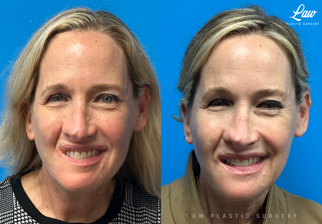 Chin Surgery (Genioplasty) Before and After Photo. Surgery performed in Dallas, TX at Law Plastic Surgery.