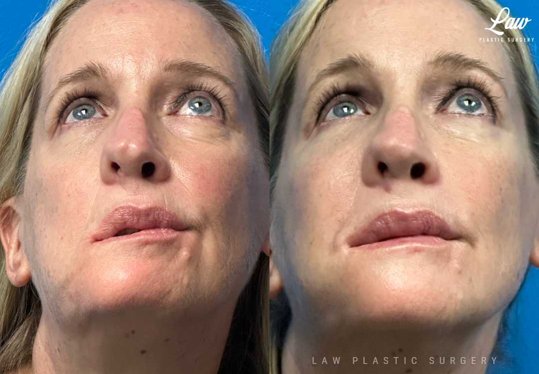Chin Surgery (Genioplasty) Before and After Photo. Surgery performed in Dallas, TX at Law Plastic Surgery.