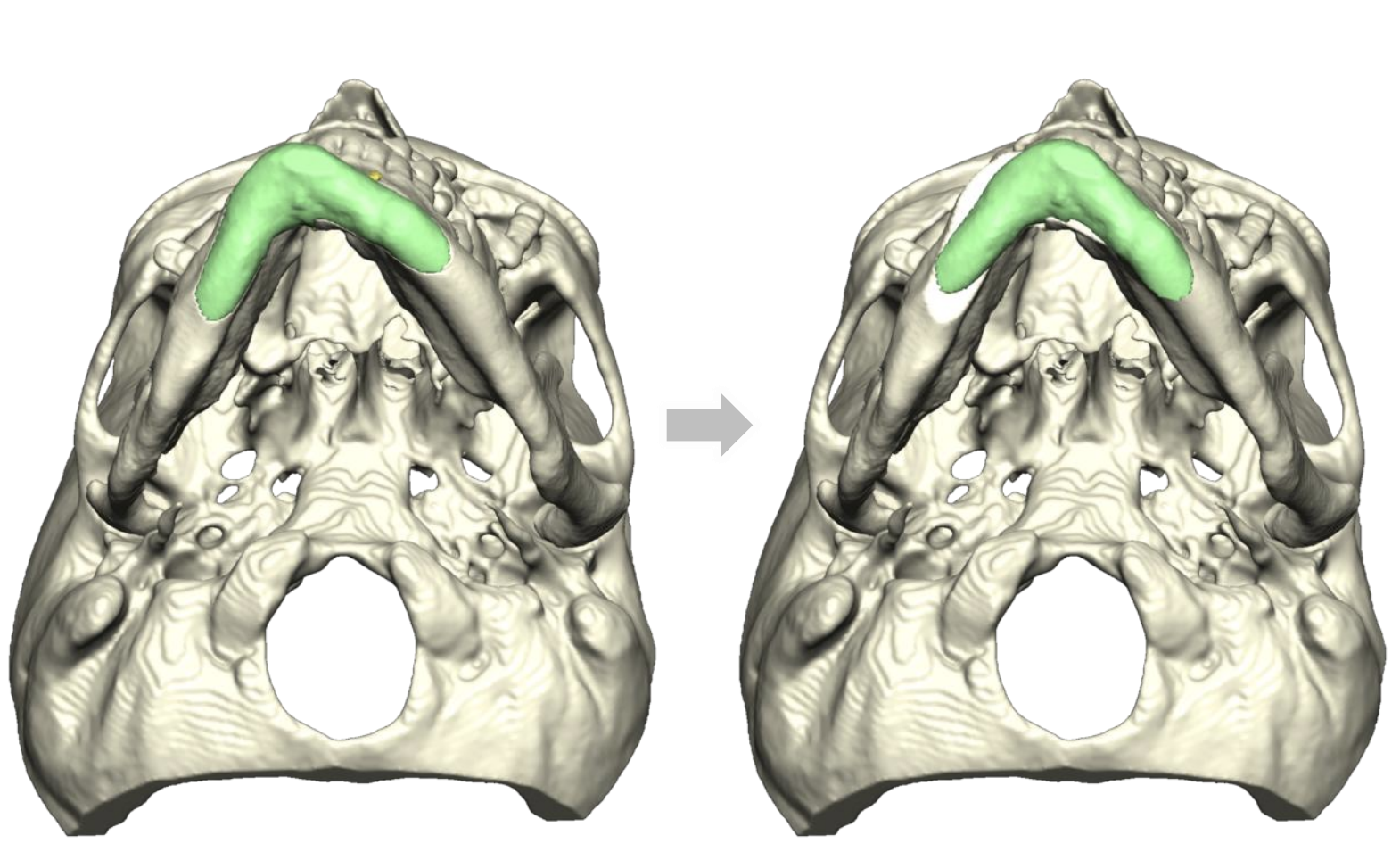 Chin Surgery (Genioplasty) Before and After Photo. Surgery performed in Dallas, TX at Law Plastic Surgery.