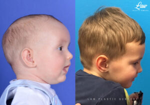 Craniosynostosis Before and After Photo. Surgery performed in Dallas, TX at Law Plastic Surgery.