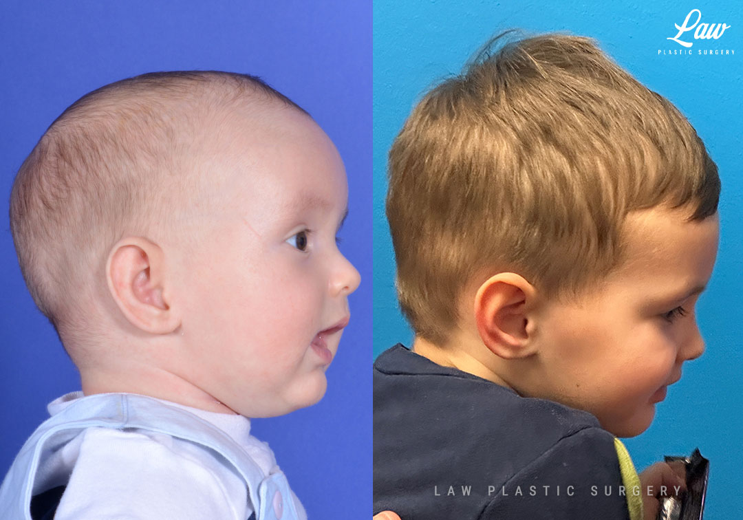 Craniosynostosis Before and After Photo. Surgery performed in Dallas, TX at Law Plastic Surgery.