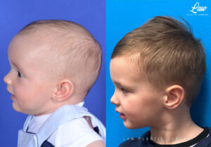 Craniosynostosis Before and After Photo. Surgery performed in Dallas, TX at Law Plastic Surgery.