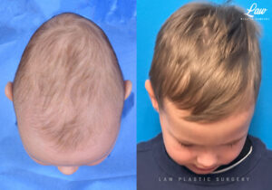 Craniosynostosis Before and After Photo. Surgery performed in Dallas, TX at Law Plastic Surgery.
