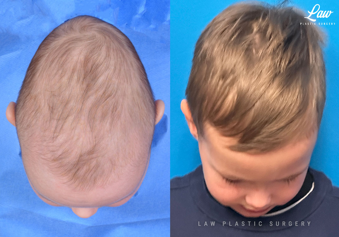 Craniosynostosis Before and After Photo. Surgery performed in Dallas, TX at Law Plastic Surgery.