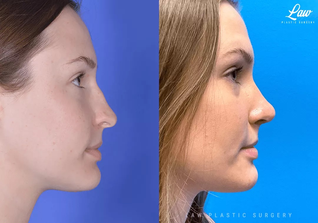 Dallas Septoplasty Before & After Photo. Septoplasty performed in Dallas, TX at Law Plastic Surgery.