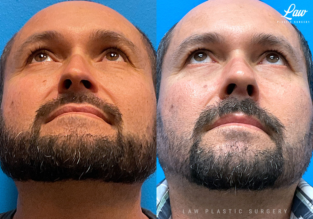 Dallas Septoplasty Before & After Photo. Septoplasty performed in Dallas, TX at Law Plastic Surgery.