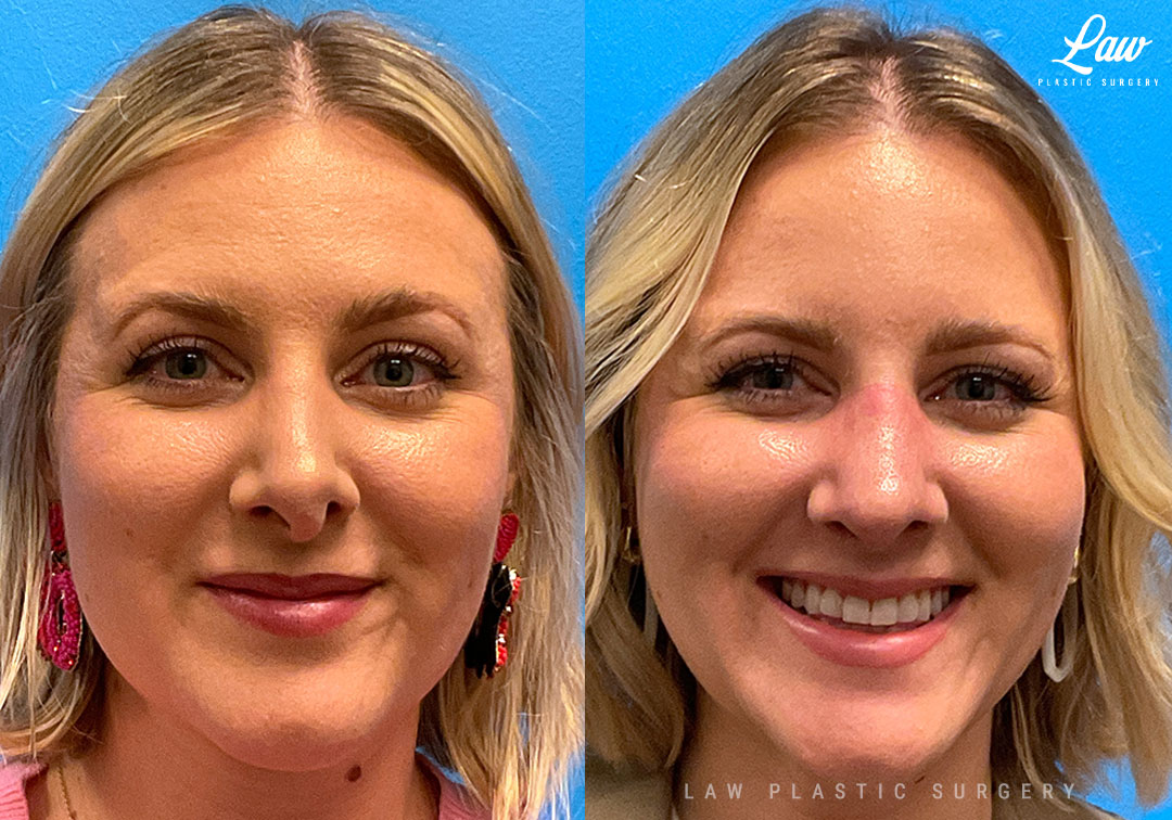 Dallas Septoplasty Before & After Photo. Septoplasty performed in Dallas, TX at Law Plastic Surgery.