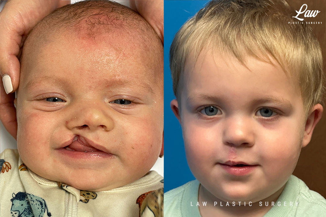 Cleft Lip Repair Before & After Photo. Surgery performed in Dallas, TX at Law Plastic Surgery.