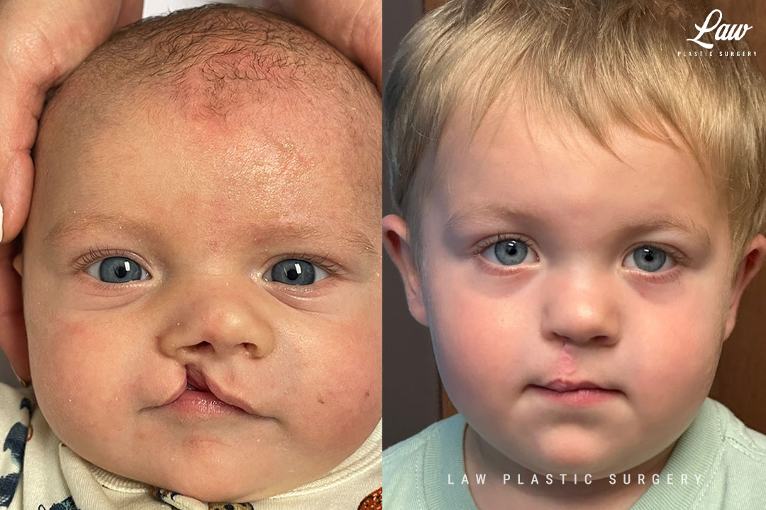 Cleft Lip Repair Before & After Photo. Surgery performed in Dallas, TX at Law Plastic Surgery.