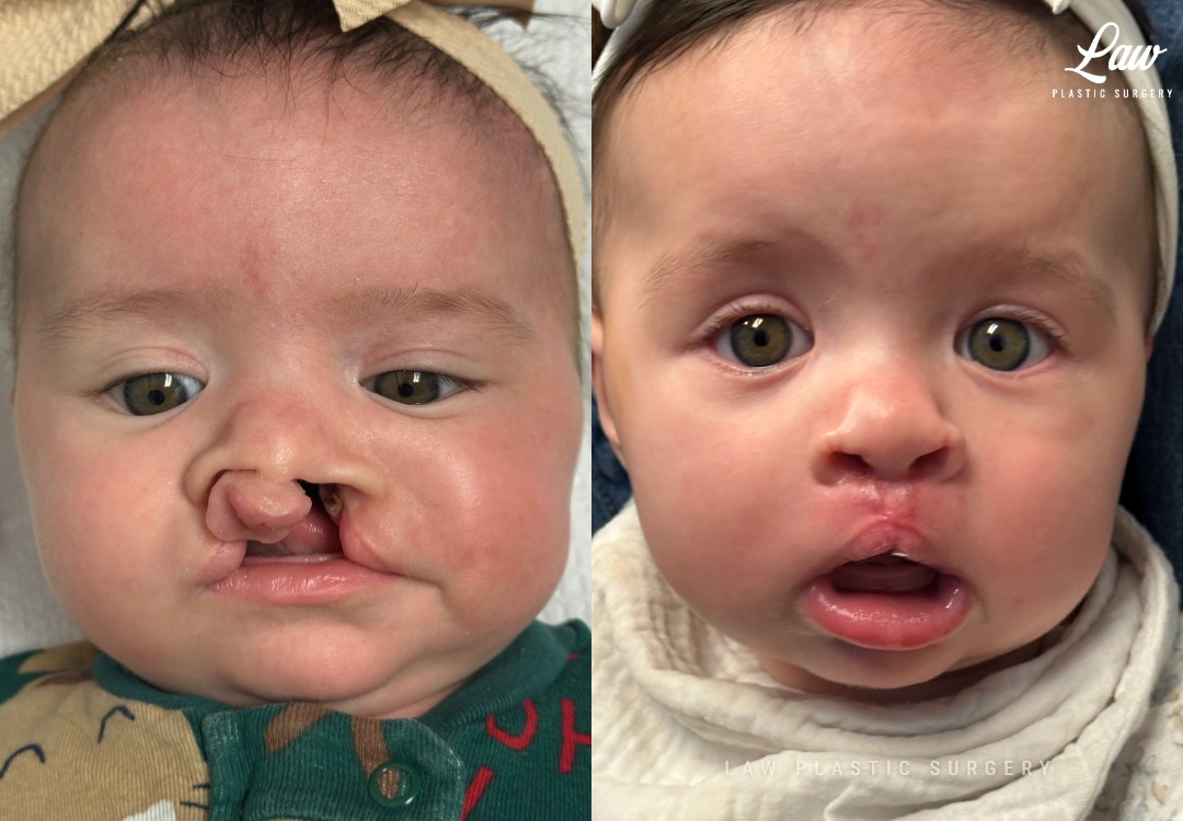 Cleft Lip Repair Before & After Photo. Surgery performed in Dallas, TX at Law Plastic Surgery.