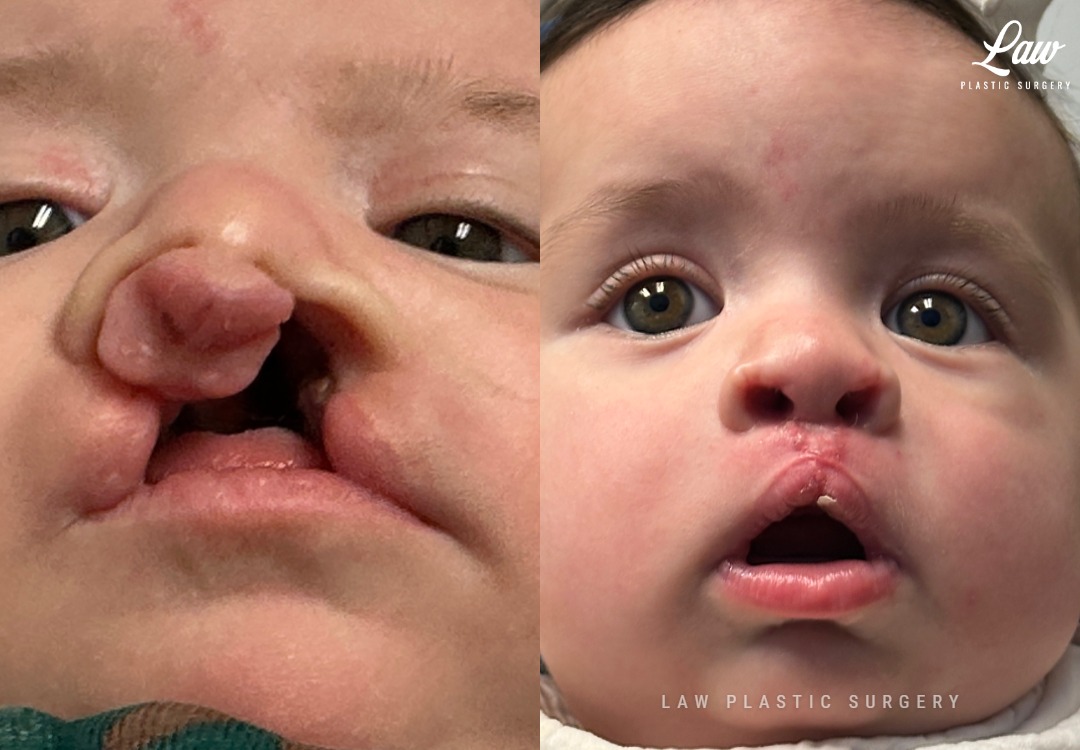 Cleft Lip Repair Before & After Photo. Surgery performed in Dallas, TX at Law Plastic Surgery.