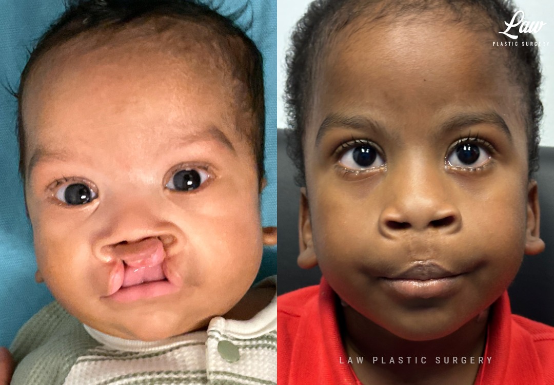 Cleft Lip Repair Before & After Photo. Surgery performed in Dallas, TX at Law Plastic Surgery.