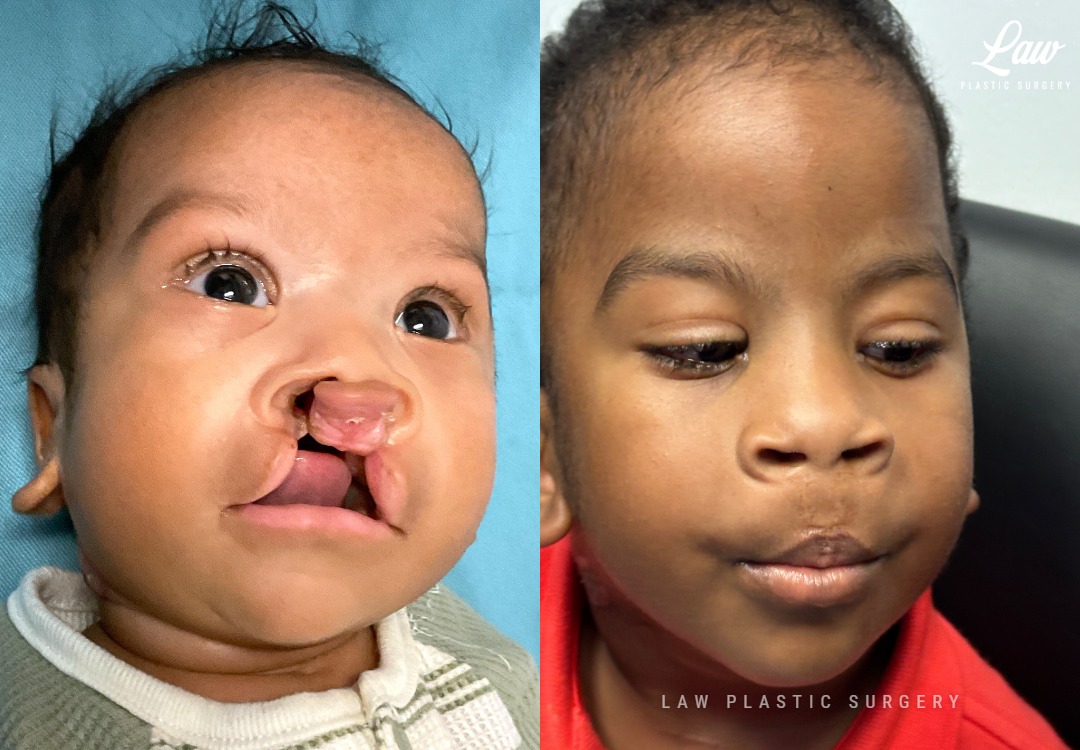 Cleft Lip Repair Before & After Photo. Surgery performed in Dallas, TX at Law Plastic Surgery.