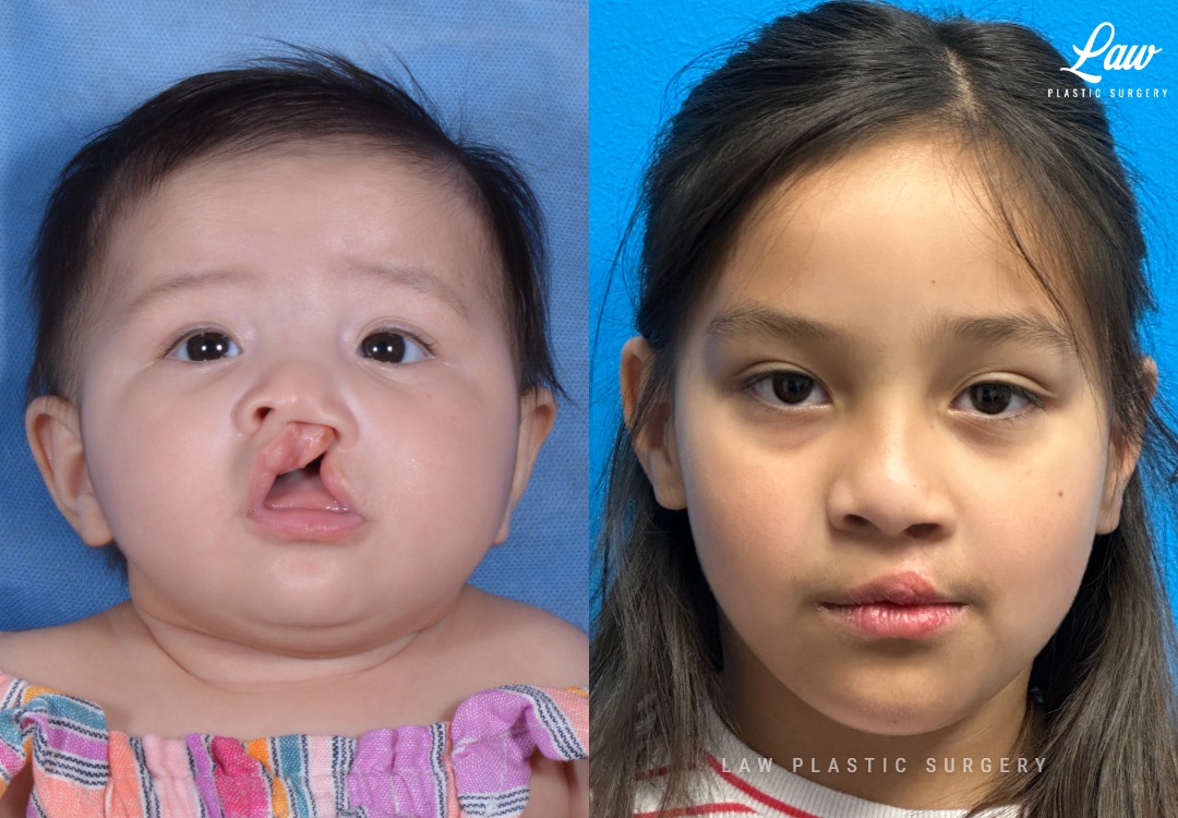 Cleft Lip Repair Before & After Photo. Surgery performed in Dallas, TX at Law Plastic Surgery.