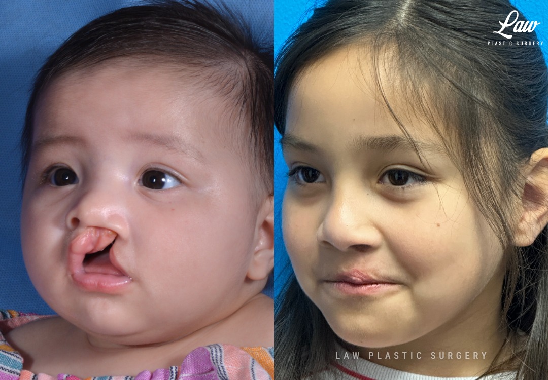Cleft Lip Repair Before & After Photo. Surgery performed in Dallas, TX at Law Plastic Surgery.