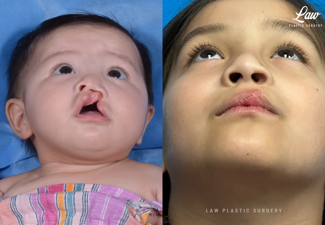 Cleft Lip Repair Before & After Photo. Surgery performed in Dallas, TX at Law Plastic Surgery.