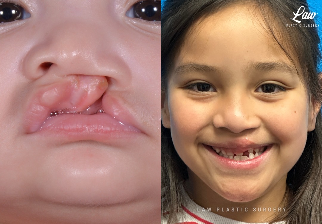 Cleft Lip Repair Before & After Photo. Surgery performed in Dallas, TX at Law Plastic Surgery.