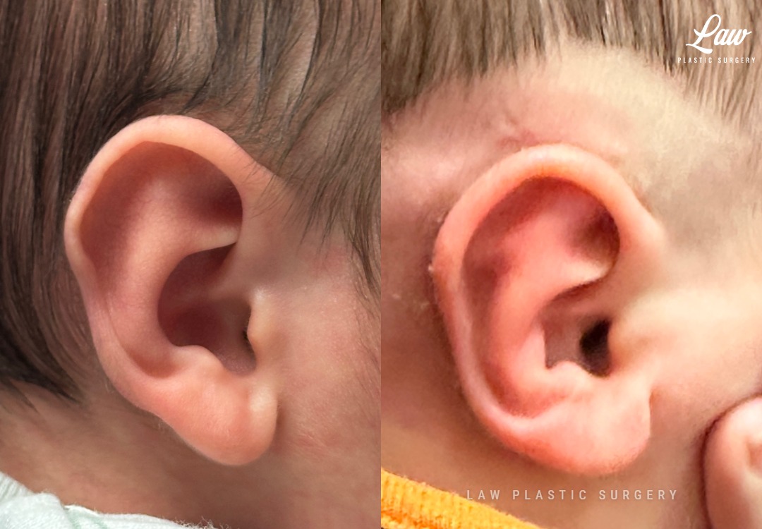 Ear Molding Before and After Photo. Surgery performed in Dallas, TX at Law Plastic Surgery.
